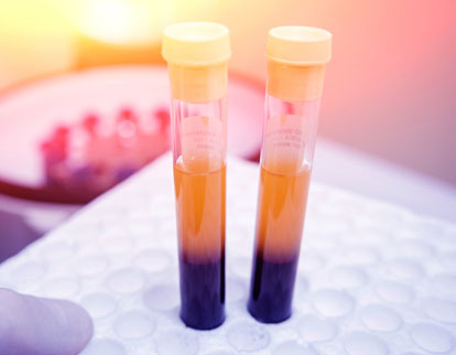 vials of platelet-rich plasma